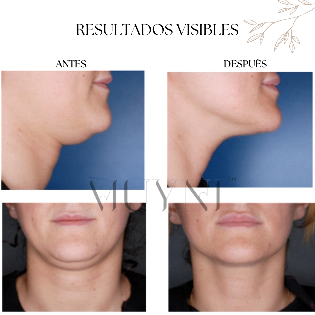 Masajeador Facial y de Papada - AURA™️